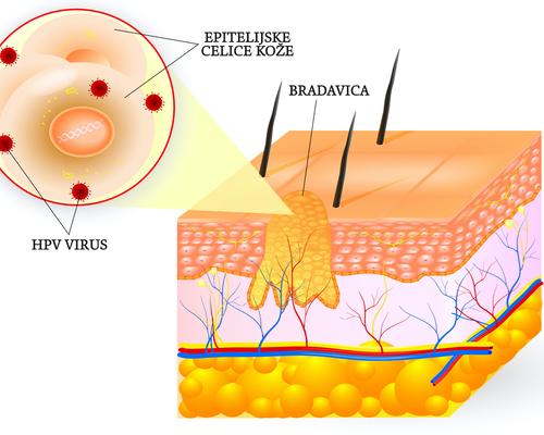 Lasersko odstranjevanje bradavic