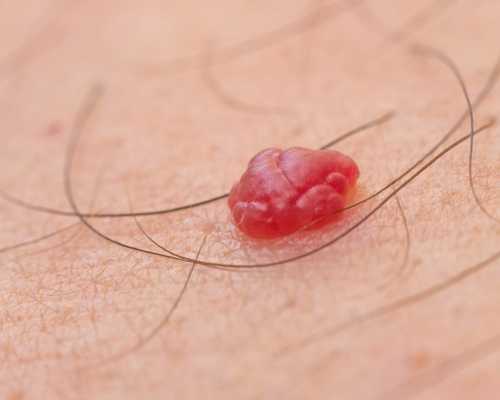 Lasersko ostranjevanje senilnih angiomov in pajkastih teleangiektazij (drobnih žil)